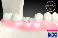 بازسازی استخوان تحلیل رفته|کلینیک دندانپزشکی مدرن