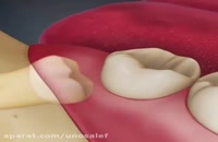 آموزش کشیدن دندان | آموزش