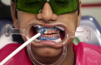 بلیچینگ دندان دندان چگونه انجام می شود