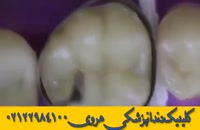 ترمیم دندان | دندانپزشکی ترمیمی و زیبایی در شمال شرق تهران