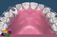 حرکت دندان نیش نهفته داخل فک به سمت قوس دندانى