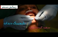 سفید کردن دندان یا بلیچینگ دندان با ژل - دستگاه پیشرفته - زیبایی سنتر
