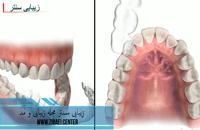 ارتودنسی نامرئی دندان,اصلاح فرم دندان در دندانپزشکی,زیبایی سنتر