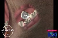 روکش دندان به جهت زیبایی|کلینیک دندانپزشکی مدرن