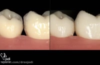 پرکردن دندان با مواد سفید خوبه یا سیاه