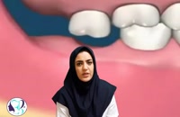 فیلم توضیحات کامل دکتر سمیه ابراهیم گل درباره کشیدن دندان عقل قسمت اول